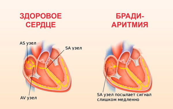 Брадиаритмия